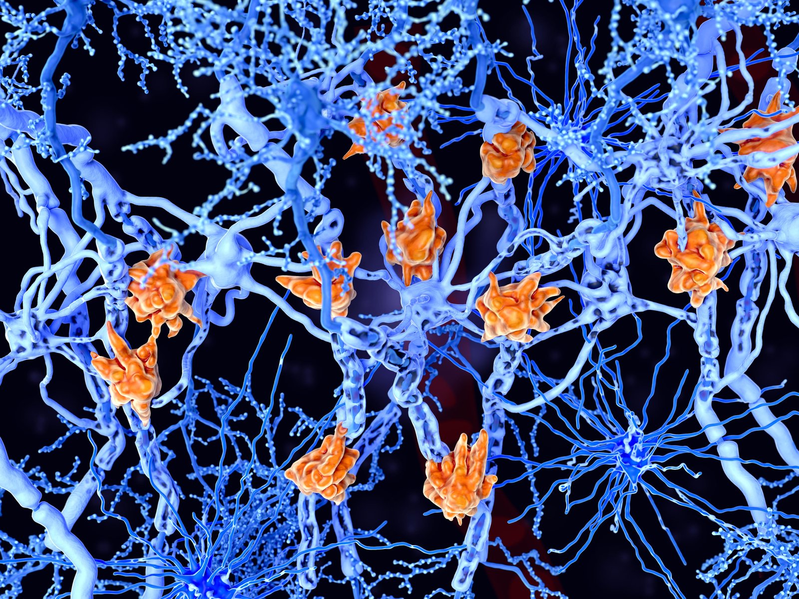 Representación de neuronas afectadas por EM (Shutterstock)