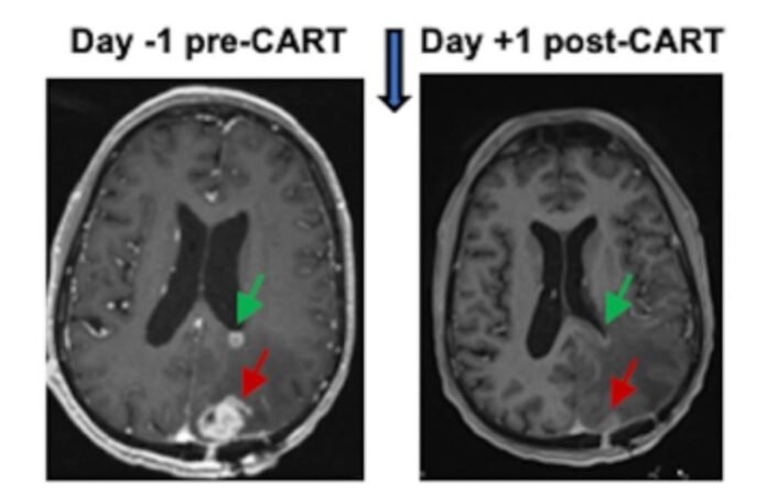 Una nueva terapia centrada en el sistema inmunitario logró reducir tumores cerebrales